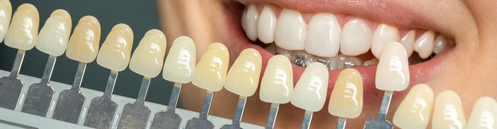 Tooth shade-matching tool next to woman's smile.